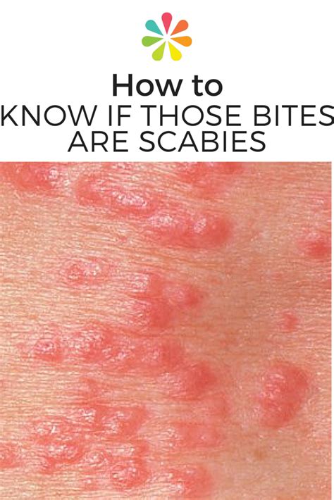 scabies  skin rash scabies symptoms pictures treatment