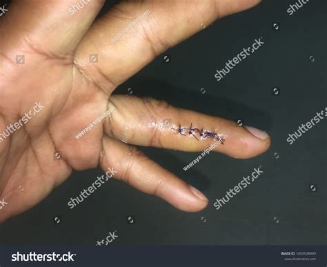 how to know if i need stitches on finger