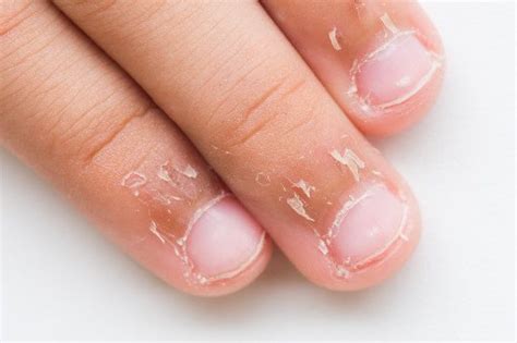 Celular antigo nokia | Roer unhas, Dedos da mão, Roendo as unhas