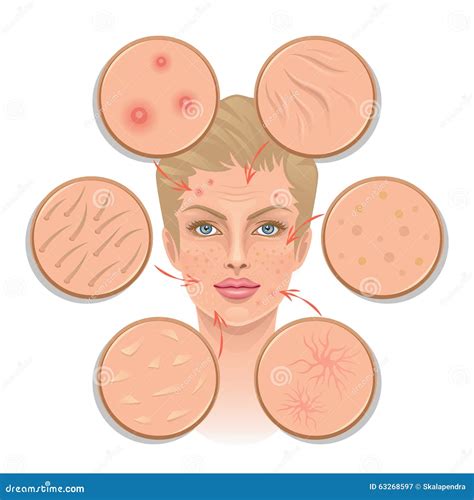 Skin Abscess. INFOGRAPHIC HEALTH CARE. Royalty-Free Stock Photo
