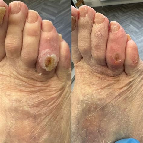 Corns & Calluses - LR Podiatry