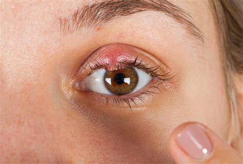 Can You Get A Stye From The Eye Doctor at Stephanie Cottrell blog
