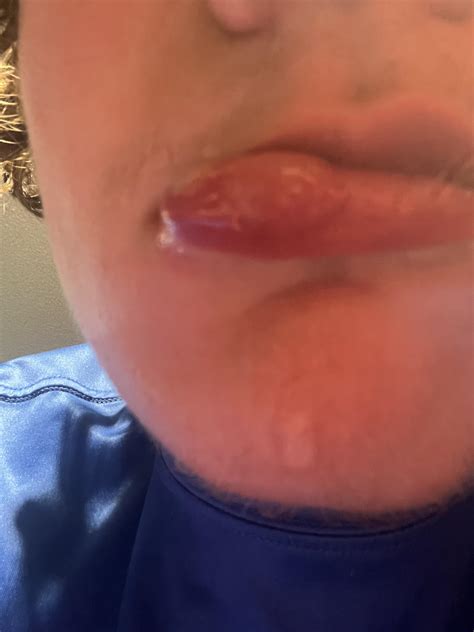 My canker sore made my lip inflamed what should I do? : r/CankerSores