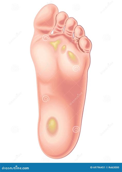 Plantar Hyperkeratosis Vector / Human Anatomy | CartoonDealer.com