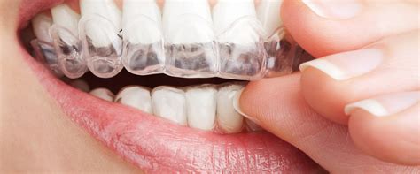 Can You Change Invisalign Trays Every 5 Days? - An Expert's Perspective