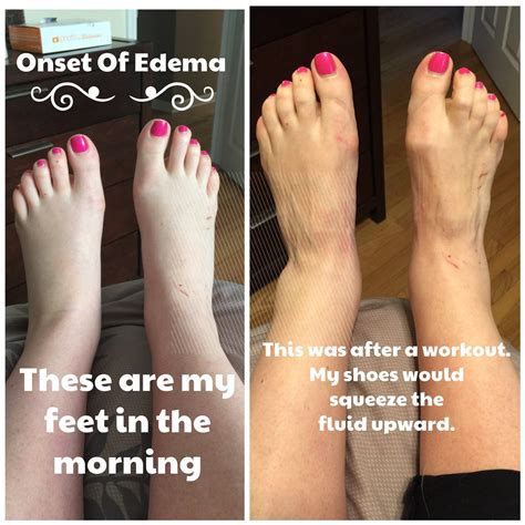 Pregnant Swollen Feet