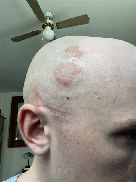 Is this ringworm? : r/Hair