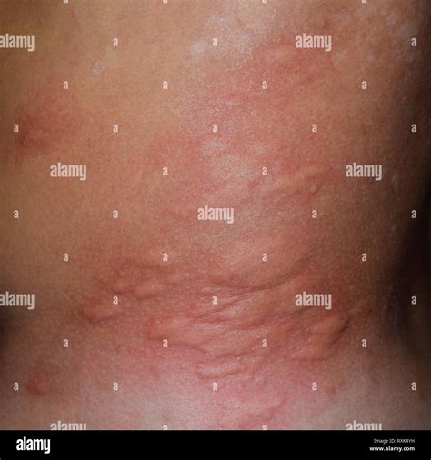 Skin Rash That Causes Swelling at James Mansell blog