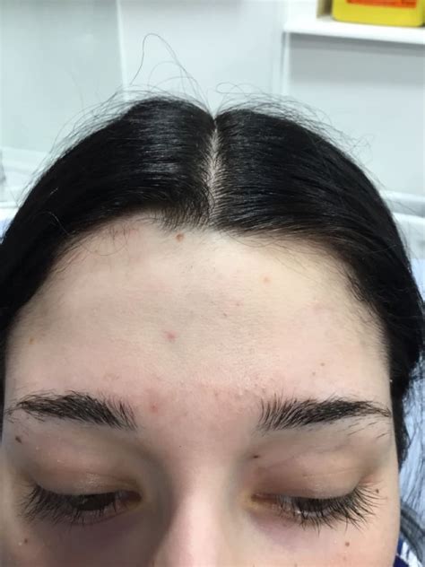 Excess Hair - Epsom Skin Clinic