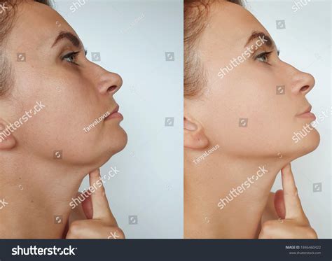 Woman Double Chin Before After Treatment Stock Photo 1846460422 | Shutterstock