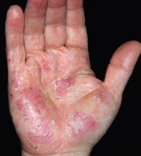 Dyshidrotic Eczema Stages | My XXX Hot Girl