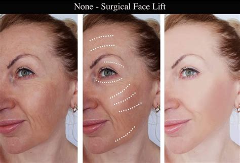 surgical face lift skin clinic marlow buckinghamshire