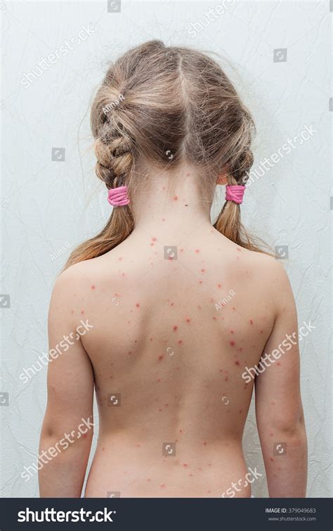 Little kids back with spots of chicken pox. - Royalty Free Stock Photo ...
