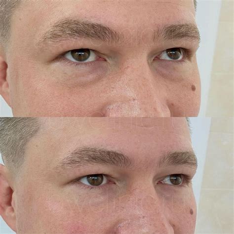 Ботокс лица для мужчин: цены в Москве | Стоимость инъекций Botox для ...