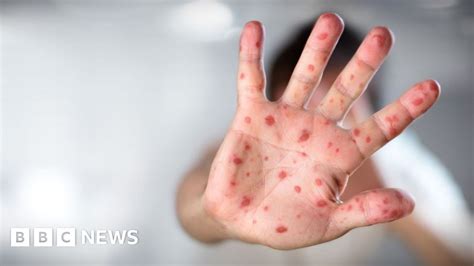 Measles warning for European travel over festive period
