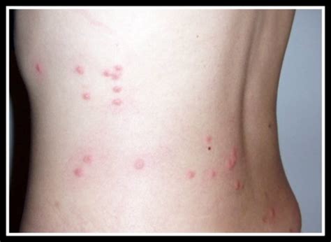 treat human flea bites  joy herman blog