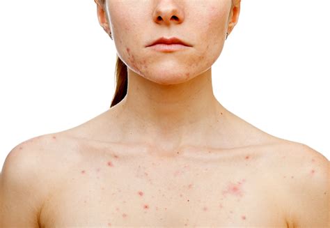 Sarecycline approved for moderate-to-severe acne