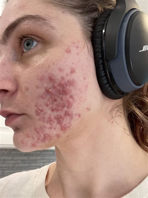 Hormonal Acne : r/acne