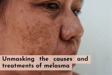 Unmasking the causes and treatments of melasma - SkinQure