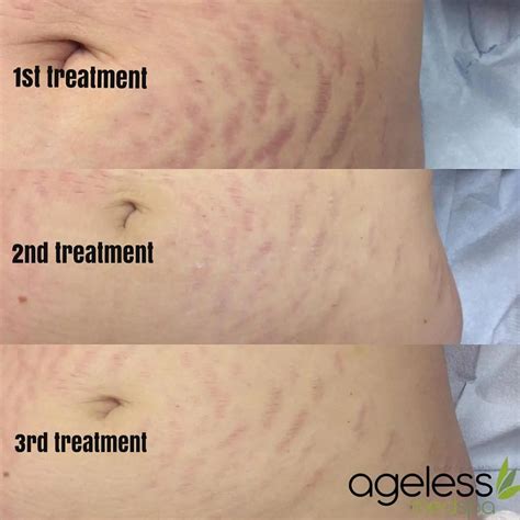 fractional laser treatment parameters  stretch marks