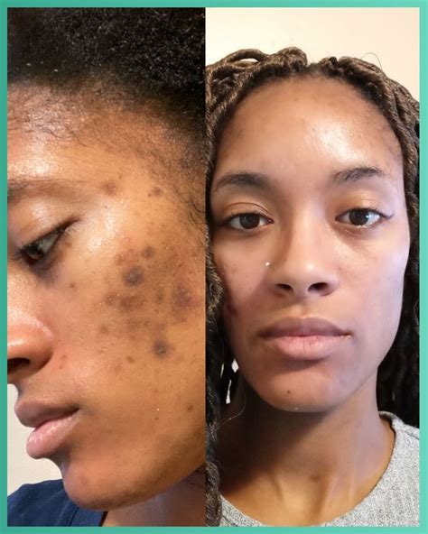 hyperpigmentation   perfec tone results skincare good
