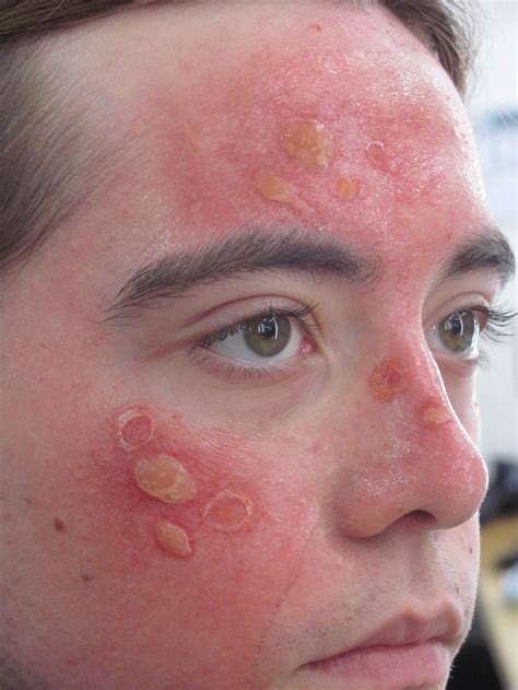 Face Rash Looks Like Sunburn at Gayle Poston blog