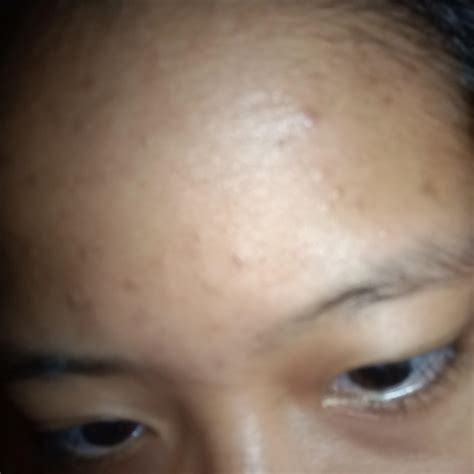 Pityrosporum Folliculitis Forehead