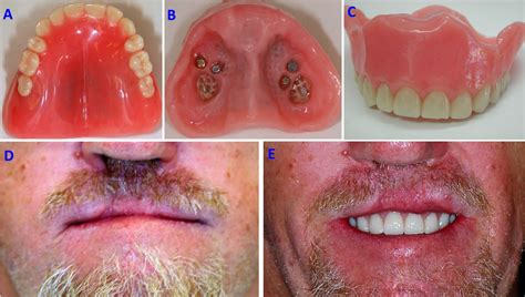 How To Remove The Palate From Dentures at Mark Villa blog
