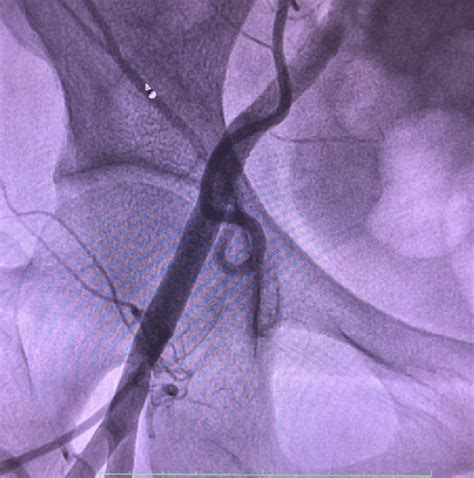 Example of introducer inserted in the femoral artery. for cardiac... | Download Scientific Diagram