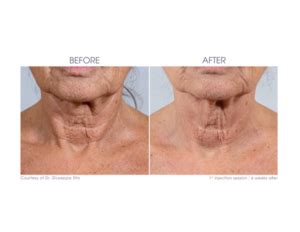 redensity  skin boosters aesthetics skin care clinic  north