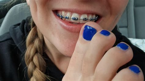 Okay, to be honest. I love to match my toes with my braces. And I am