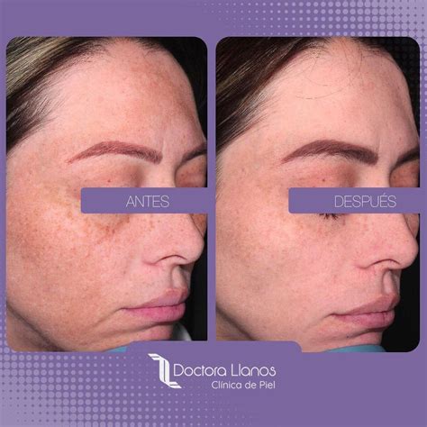 tratamiento  quitar las pecas dermatologa lina llanos