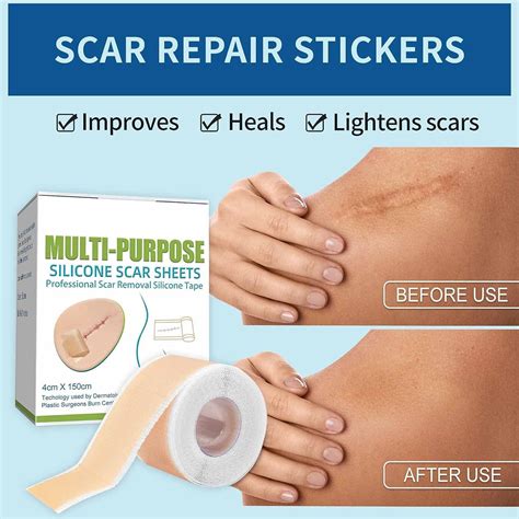 Medical Grade Silicone Scar Sheets - 1.6 x 60 inches - C-Section