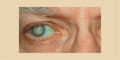 ¿Qué son las cataratas en el ojo?