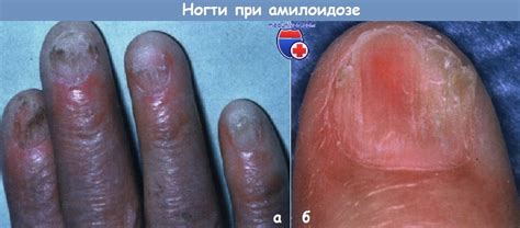 Причины появления борозд и отсутствия блеска ногтей