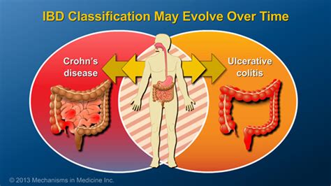Slide Show - Diagnosing IBD