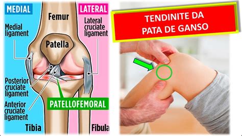 O Que É Pata De Ganso No Joelho - JOELHO - TENDINITE DA PATA DE GANSO - YouTube