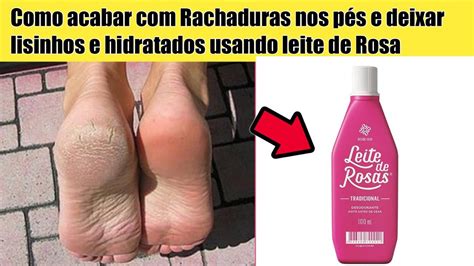 O Que E Bom Para Rachadura Nos Pes