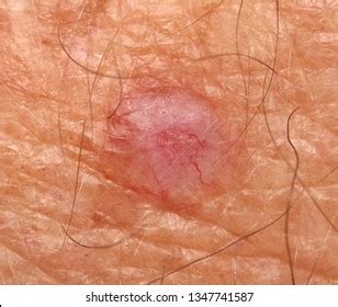 1+ Thousand Basal Cell Carcinoma Royalty-Free Images, Stock Photos ...