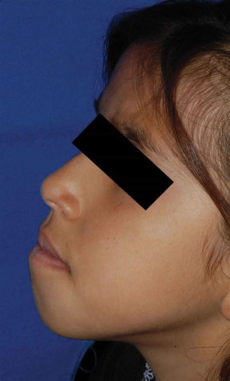 Mandibular Prognathism Orthodontic Preparation For Orthognathic