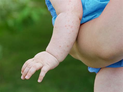 Viral rash baby: Pictures, types, and diagnosis