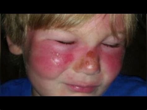 Swimming With second Degree Burns - Fitness | NoahStrength.com