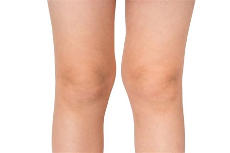 Knock knees - myDr.com.au
