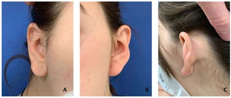 left frontal view    ear middle frontal view   left