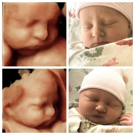 5D/HD Live Ultrasound