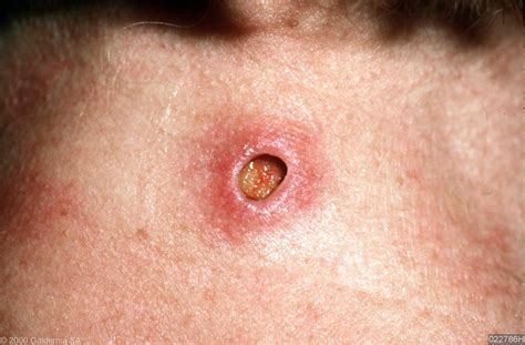 Epidermoid Cyst
