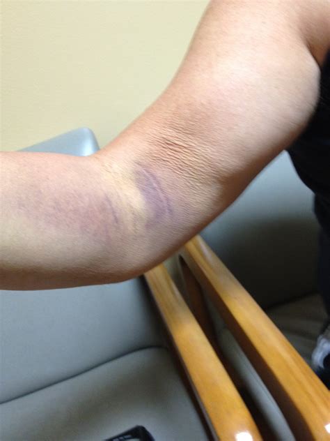 Bruised Tendon Forearm
