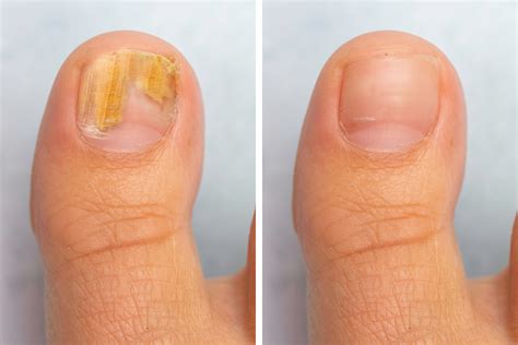 Laser therapy for fungal nails? Does it really work? | Foot Right Podiatry