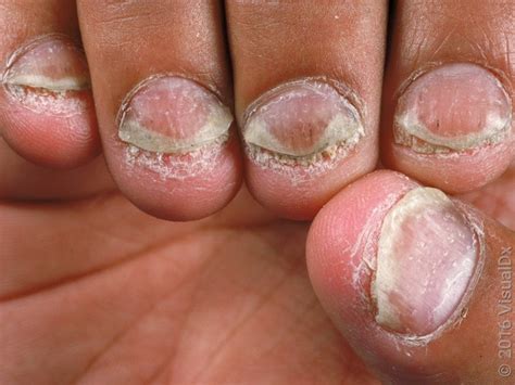 8 Ways Psoriatic Arthritis Affects the Nails - GoodRx