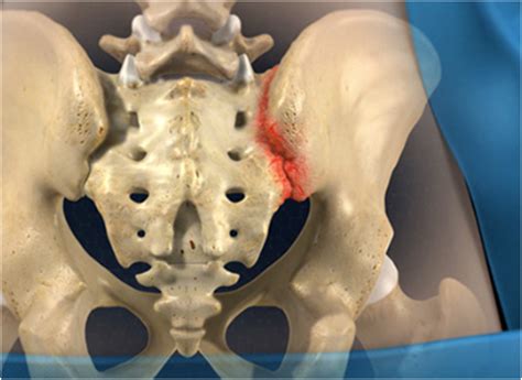 sacroiliac joint xray